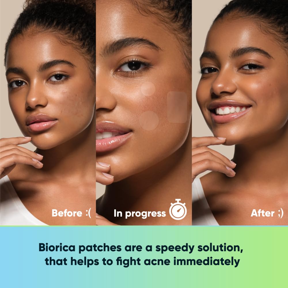 Pimple Patches for Face with Tea Tree Oil 132 pcs. Hydrocolloid Acne Pimple Patches. Blemish Patches, Acne Dots, Pimple Stickers, Acne Patch and Pimple Patch Pimple Patches for Face with Tea Tree Oil 132 pcs. Hydrocolloid Acne Pimple Patches. Blemish Patches, Acne Dots, Pimple Stickers, Acne Patch and Pimple Patch